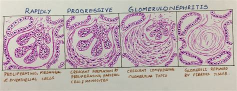 RPGN and structureof the crescent – Histopathology.guru