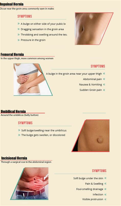 Hernia- Types, Symptoms, Causes, & Treatment - Tynor Australia