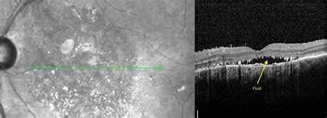 Central Serous Retinopathy - Texoma