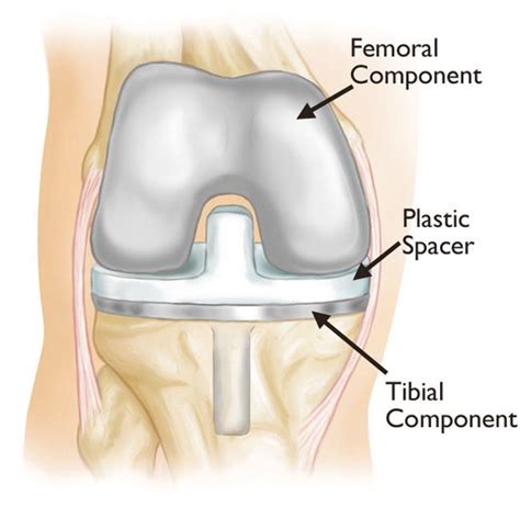 Revision Total Knee Replacement - OrthoInfo - AAOS