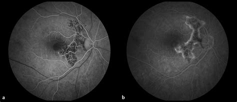 Serpiginous Choroiditis | Ento Key