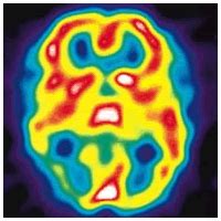 Migraines: Prodrome phase of Migraine