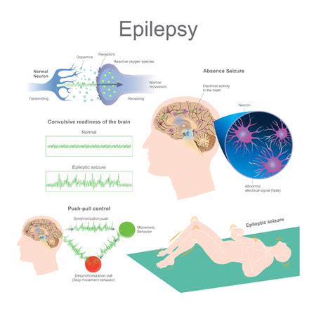 Epilepsy is a group of neurological disorders characterized by ...