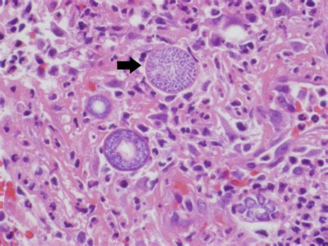 Coccidioidomycosis Histology