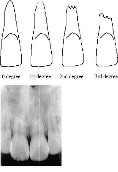 [PDF] Root resorption before and after orthodontic treatment: a clinical study of contributory ...