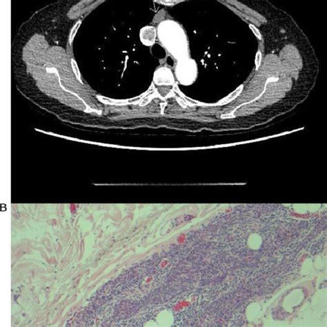 (a) Anterior mediastinal nodule compatible with a small thymoma (arrow)... | Download Scientific ...