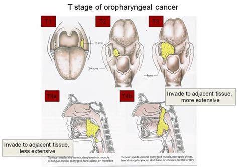 Dentistry lectures for MFDS/MJDF/NBDE/ORE: TNM Staging Of Oropharyngeal Cancer