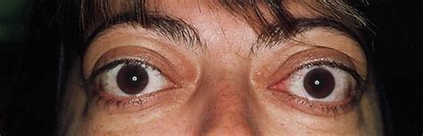 Graves’ orbitopathy refers to the part of the thyroid disorder that affects the eyes and orbital ...