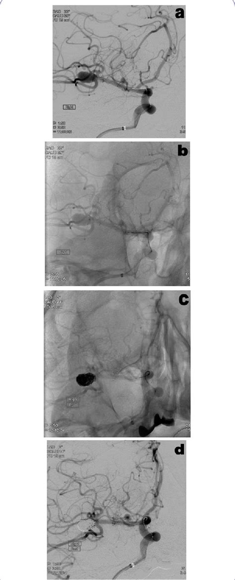 Case of a patient with an unruptured right MCA aneurysm treated with... | Download Scientific ...