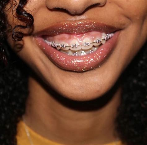 Pin by Prettyluhhziaaa on Brace face | Cute braces, Braces colors, Dental braces