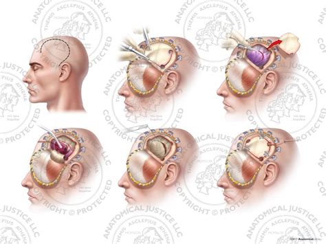 Male Left Frontotemporoparietal Craniotomy and Evacuation of Subdural Hematoma - No Text