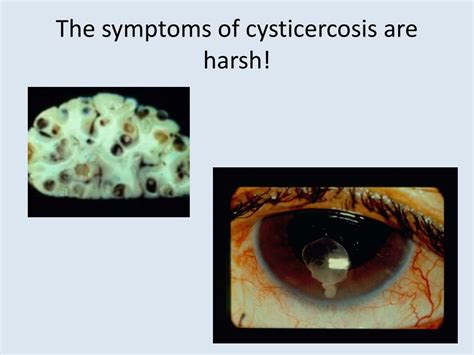 PPT - Cysticercosis (neurocysticercosis) PowerPoint Presentation - ID:545278