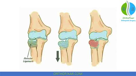 Nursemaid Elbow Reduction | OrthoFixar 2024