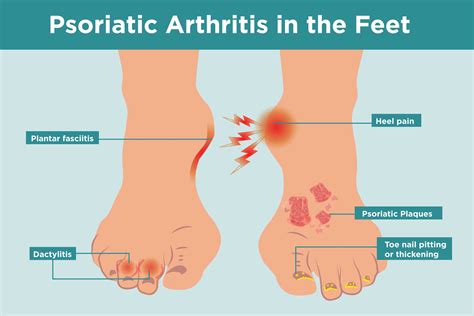 Stages Of Psoriatic Arthritis