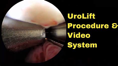 Narrated UroLift Procedure Video as shown using Redfin R3800 Digital Video System for Cystoscopy ...