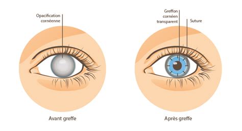 Greffe de la Cornée