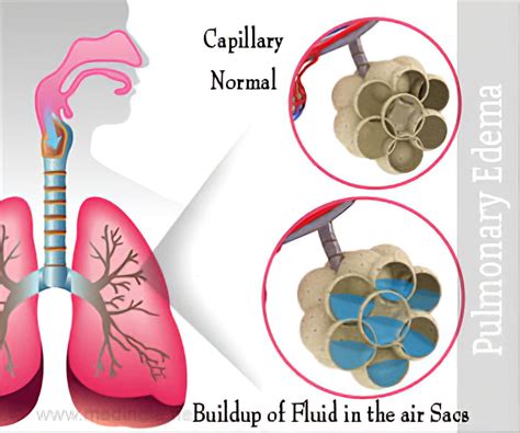 From Heart Failure Pulmonary Edema