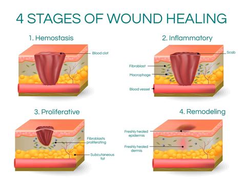 4 Stages of Wound Healing | Wound healing, Heal wounds faster, Healing