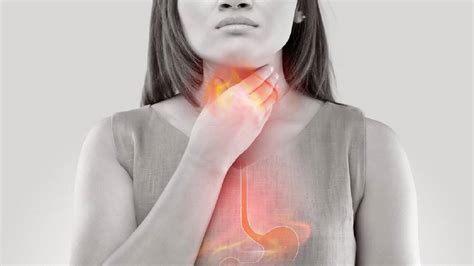 Gastroesophageal Reflux Disease