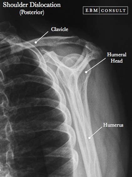 Posterior Shoulder Dislocation - General Review