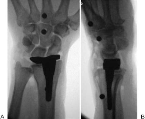 Figure 1 from Distal Radius Hemiarthroplasty. | Semantic Scholar