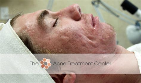 Conglobata Acne Treatment Photo | Acne Treatment Center | Portland OR ...