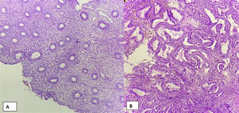 Proliferative Endometrium Histology