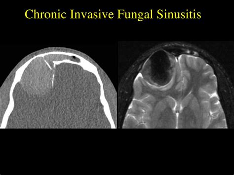 PPT - Fungal Sinusitis: An Overview PowerPoint Presentation - ID:343185