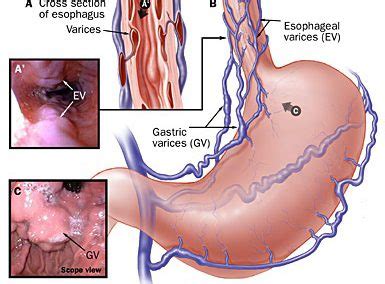 Esophageal Varices - Gastroenterologists In Florida