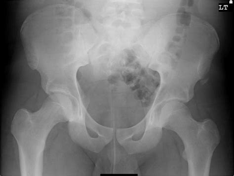 Pelvic avulsion injuries - Don't Forget the Bubbles