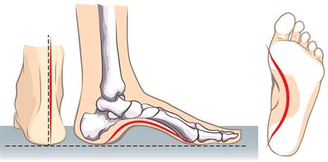 High Arches Problems: How to Relieve Foot Arch Pain - Tread Labs