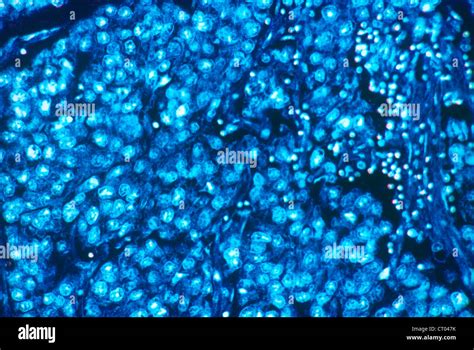 SEMINOMA, HISTOLOGY Stock Photo - Alamy