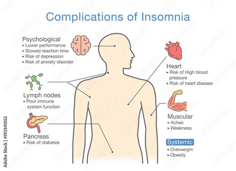 Diagram of Complications of Insomnia. llustration about effects of ...