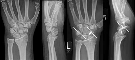 In this PLFD, both a scaphoid fracture and triquetral avulsion fracture... | Download Scientific ...