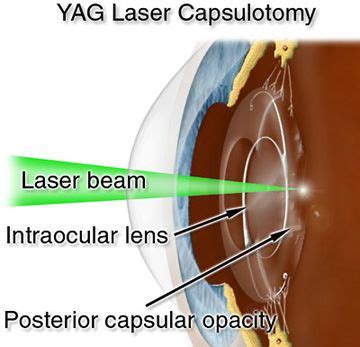 PCO - Posterior Capsule Opacification, treatment for post cataract vision blurring with Nd YAG ...