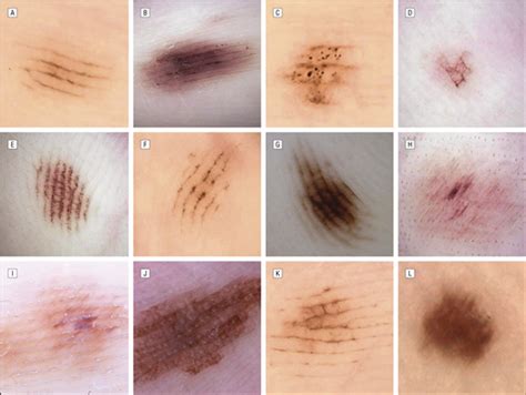 Variations in the Dermoscopic Features of Acquired Acral Melanocytic Nevi | Dermatology | JAMA ...