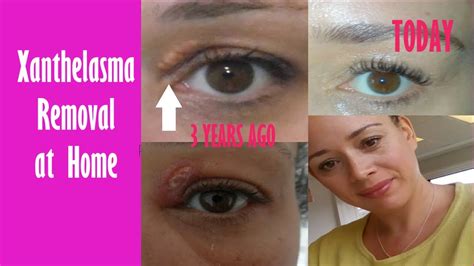 Xanthelasma Removal