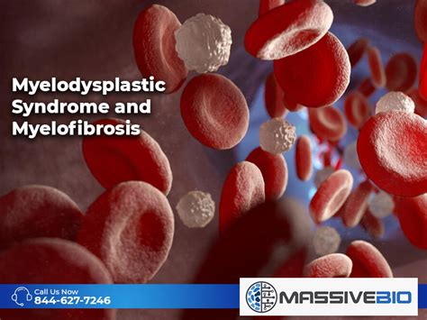 Myelofibrosis - Myelodysplastic Syndrome - Symptoms and Causes. MF ...