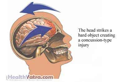 Closed Head Injury Definition, Causes, Symptoms, Complications and Cost Surgery Treatment ...