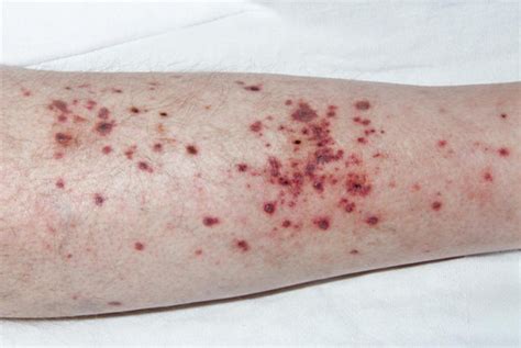 Leukocytoclastic Vasculitis (Allergic vasculitis; Cutaneous small-vessel vasculitis ...