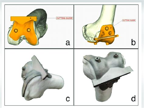 (a and b) software designing of Patient-Specific Instrument (PSI) using... | Download Scientific ...