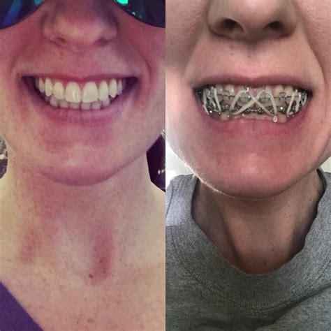 Both pics taken this morning...before and after my braces were removed ...