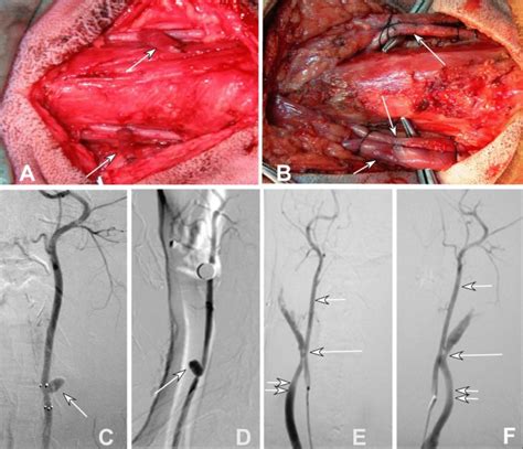 Endothelialization of PTFE-covered stents for aneurysms and arteriovenous fistulas created in ...