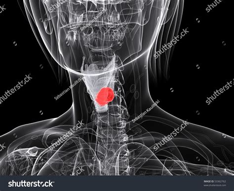 Larynx Cancer Stock Photo 53362762 : Shutterstock