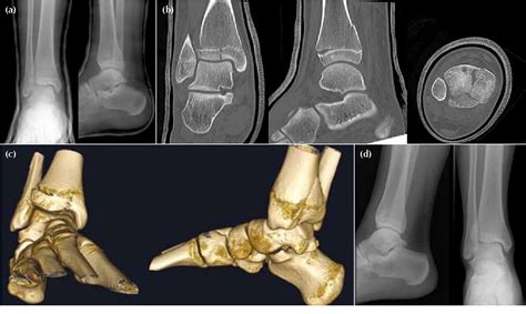 Triplane Fractures of the Distal Tibia in Children | Semantic Scholar