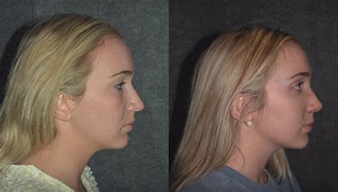 Rhinoplasty Recovery