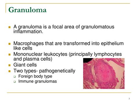 Ppt What Is Granuloma Powerpoint Presentation Free | SexiezPix Web Porn