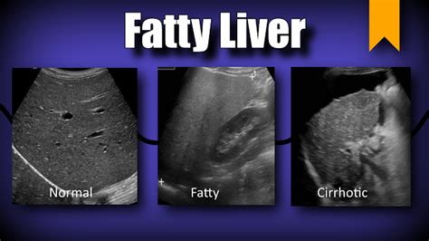 MEDICAL ULTRASOUND /FATTY LIVER