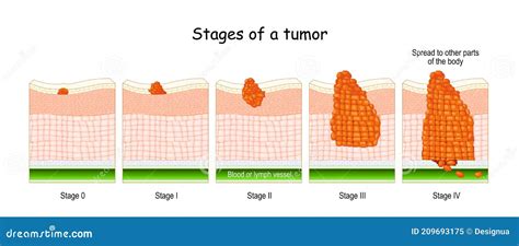 Stages Of Cancer. Classification Of Malignant Tumours Cartoon Vector | CartoonDealer.com #209693175