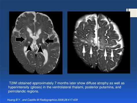 Hypoxic ischemic encephalopathy